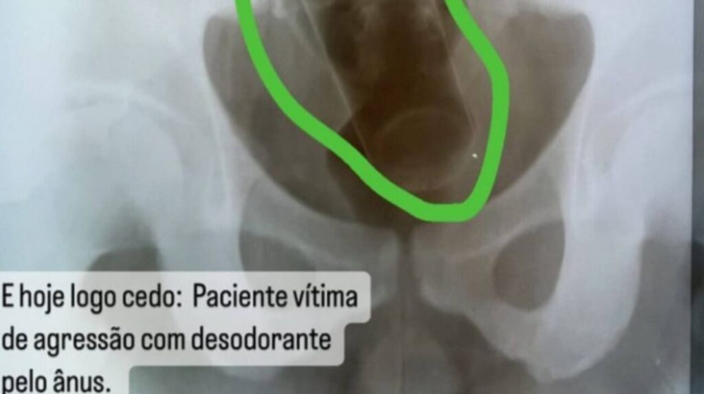 Médico é demitido após divulgar raio-X de paciente com desodorante no ânus