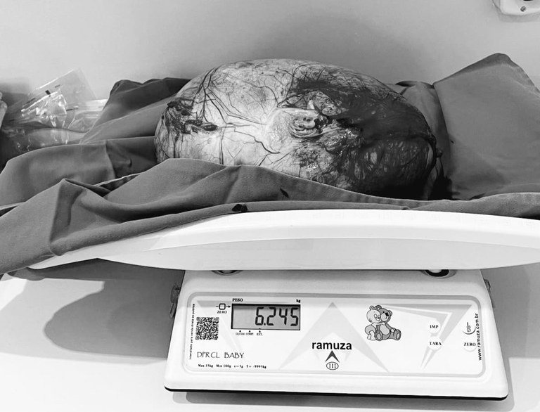 Jovem de 21 anos passa por cirurgia de emergência e retira cisto de 6,2 kg no ovário, na Paraíba